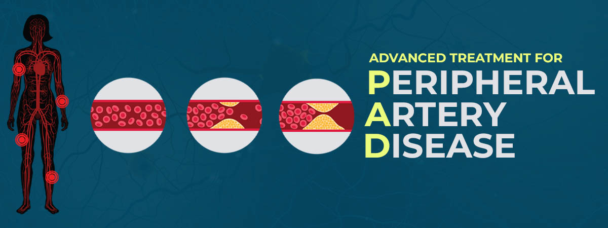 Peripheral Artery Disease treatment in Hyderabad