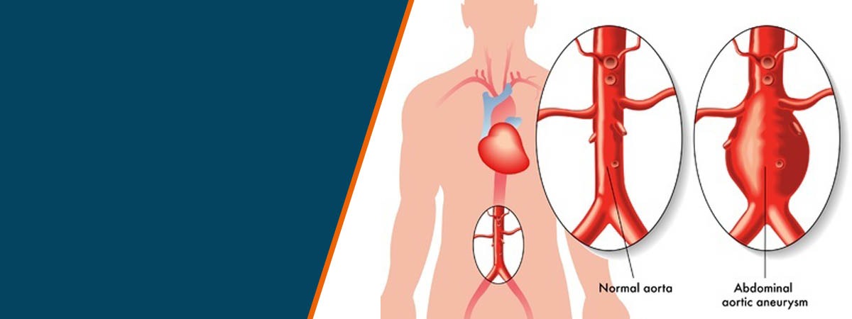aortic aneurysm treatment in Hyderabad